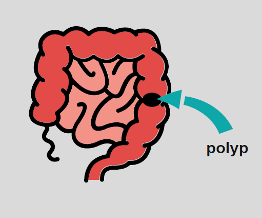 A diagram of the small and large intestine, with an arrow pointing to a polyp in the colon.