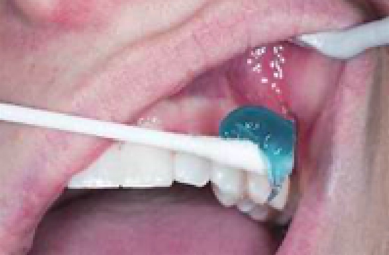 A gel being put on a tooth.